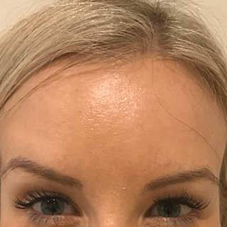 Woman's forehead