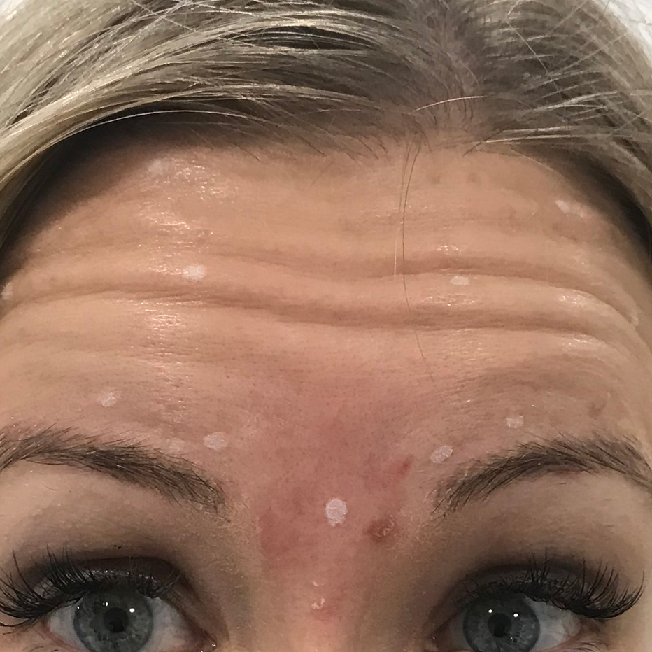 Woman's forehead with raised eyebrows