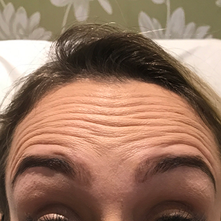 Woman's forehead with raised eyebrows