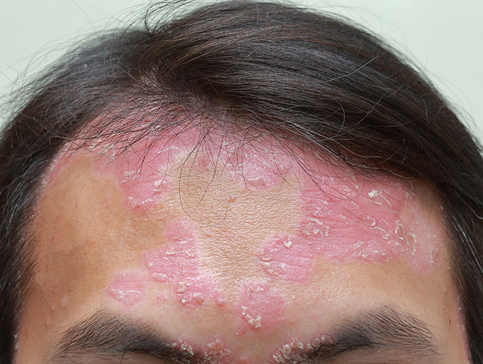 Forehead and harline showing severe psoriasis