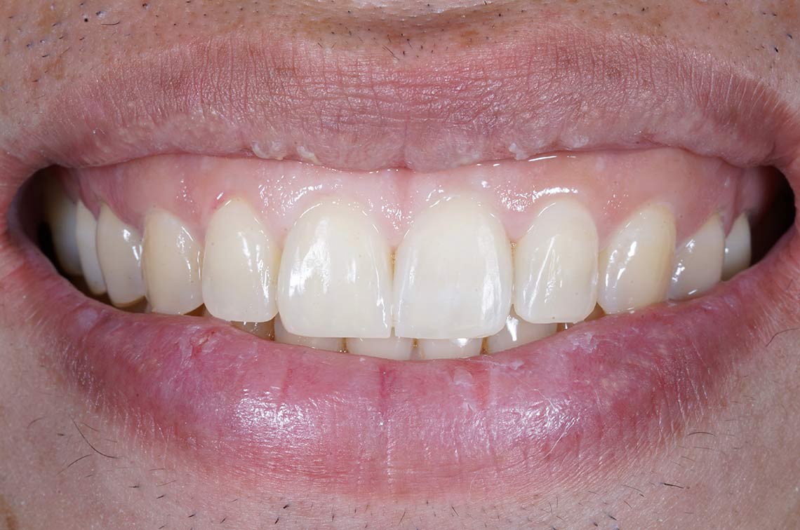 Close Up of the teeth with a very high gum line