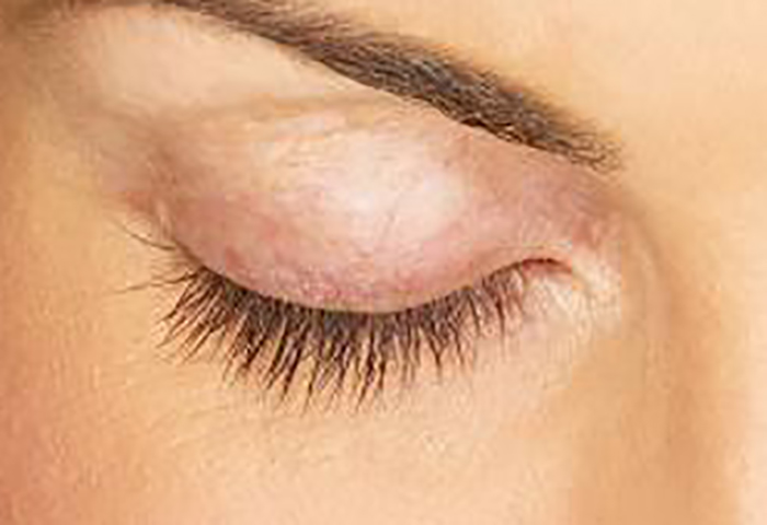 Extreme close up of an Eyelash after lumigan treatment