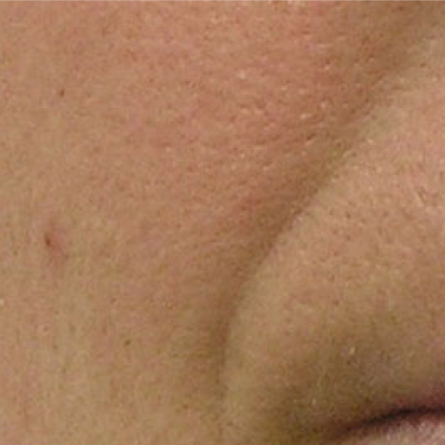 Close Up of a Woman's cheeck & lip corner before Hydrafacial Treatment