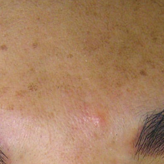 Close Up of a wmoan's forehaed before Hydrafacial treatment