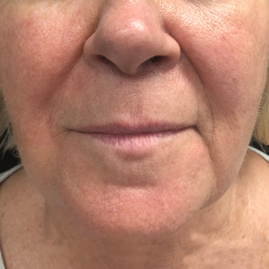 Close Up of woman's chin, cheeks and neck
