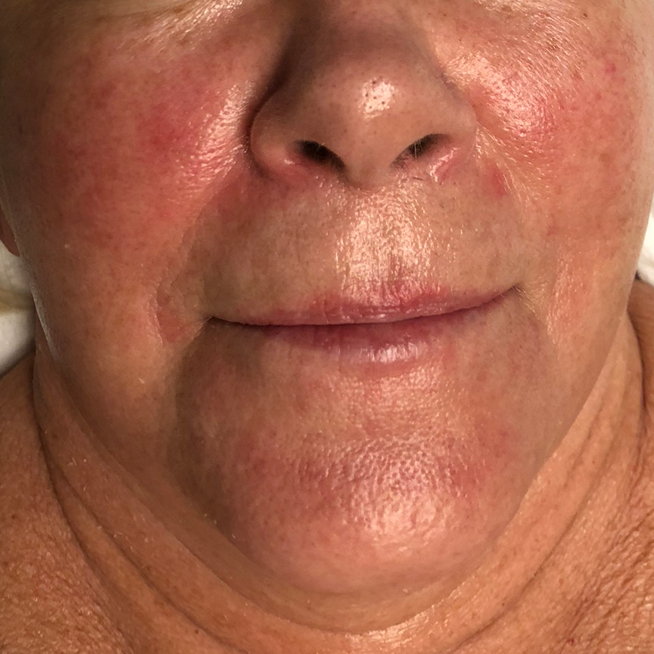 Close Up of woman's chin, cheeks and neck