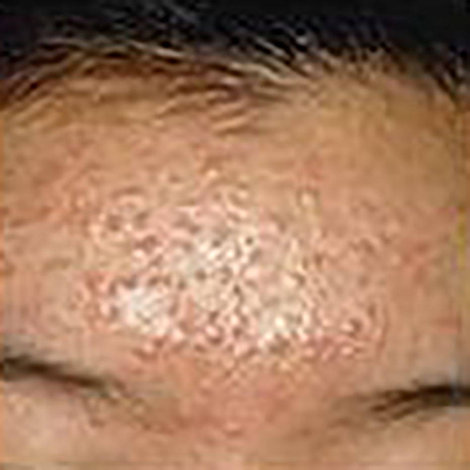 Close Up of a forehead with spotty skin
