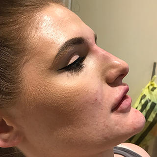Side view of ladies face and nose