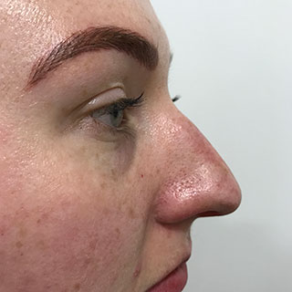 Side view of nose