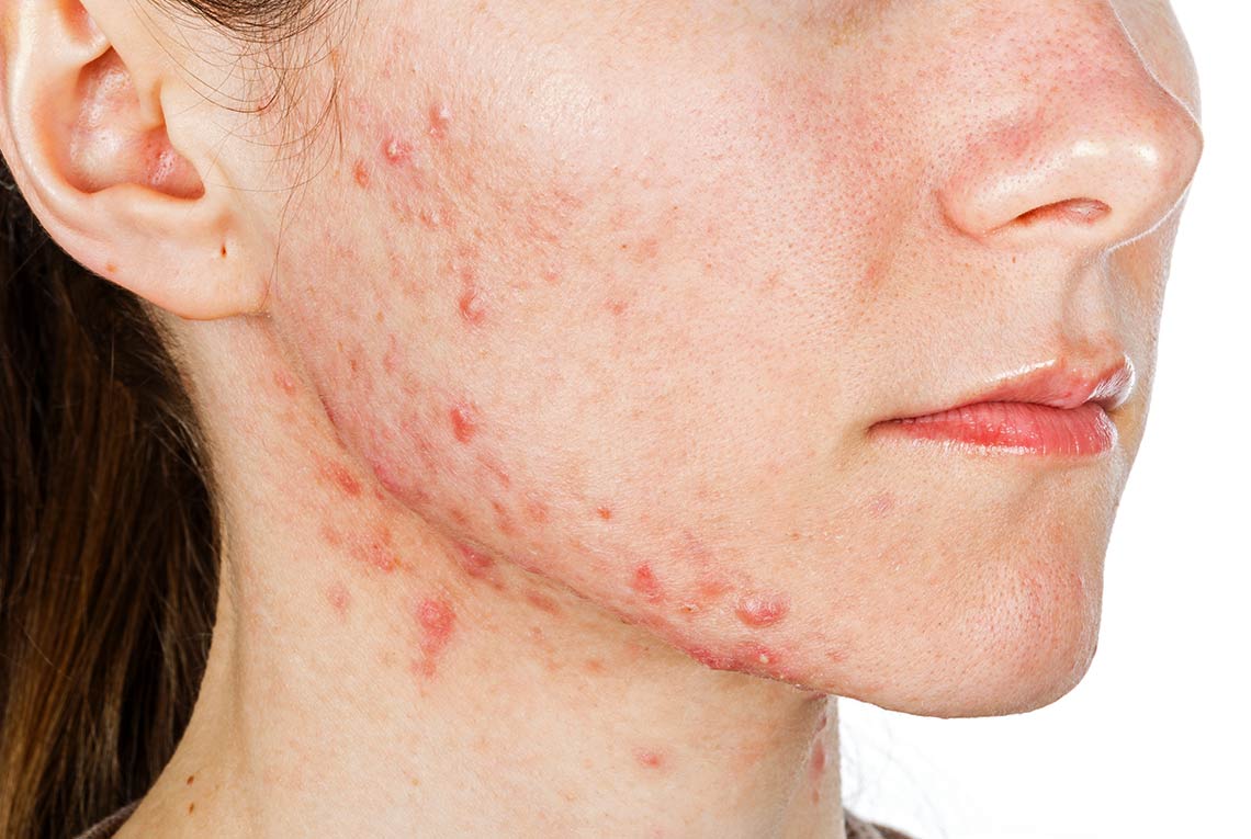 Severe Acne on the cheek and chin