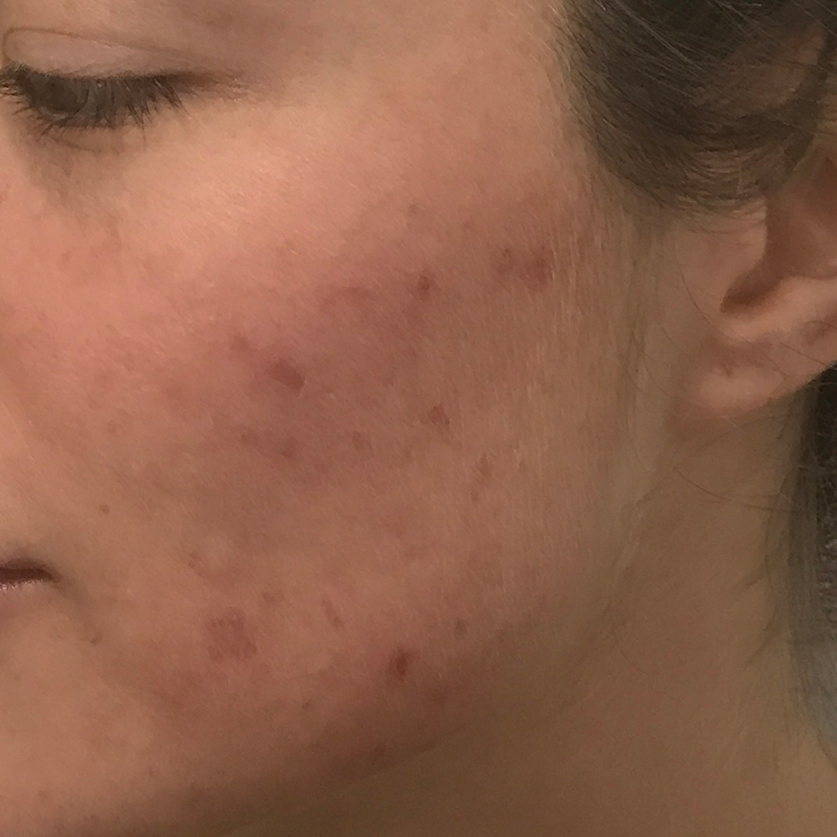 Woman's cheek with no skin blemishes