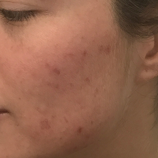 RWoman's cheek with no skin blemishes