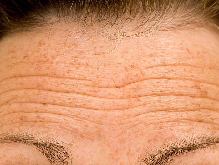 Girls cheek showing bad acne